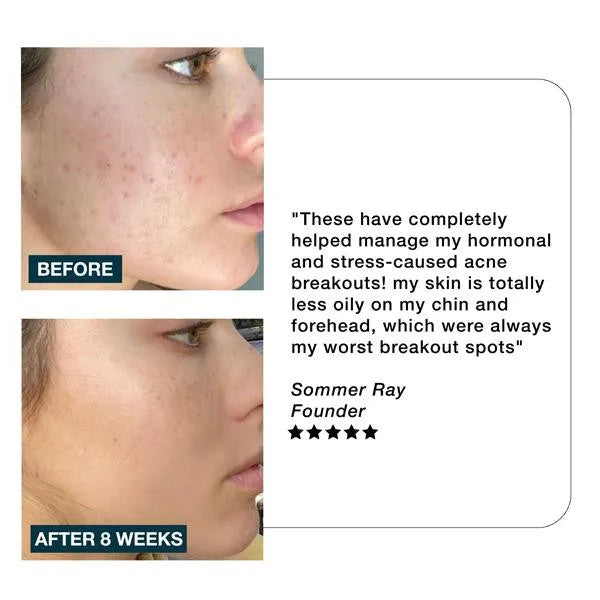 Clarity - Anti-Blemish Skincare Supplement-Imaraïs